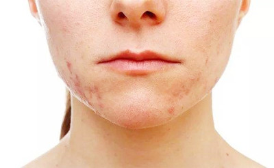 青春痘的症状有哪些呢