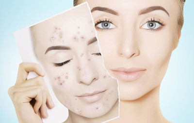 青春痘怎么才能消除