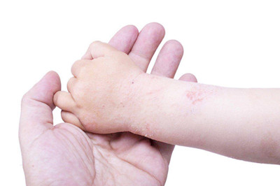 荨麻疹的危害有哪些