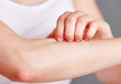 荨麻疹是否有传染性