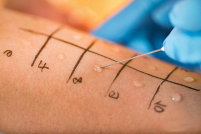 长春怎么查过敏源